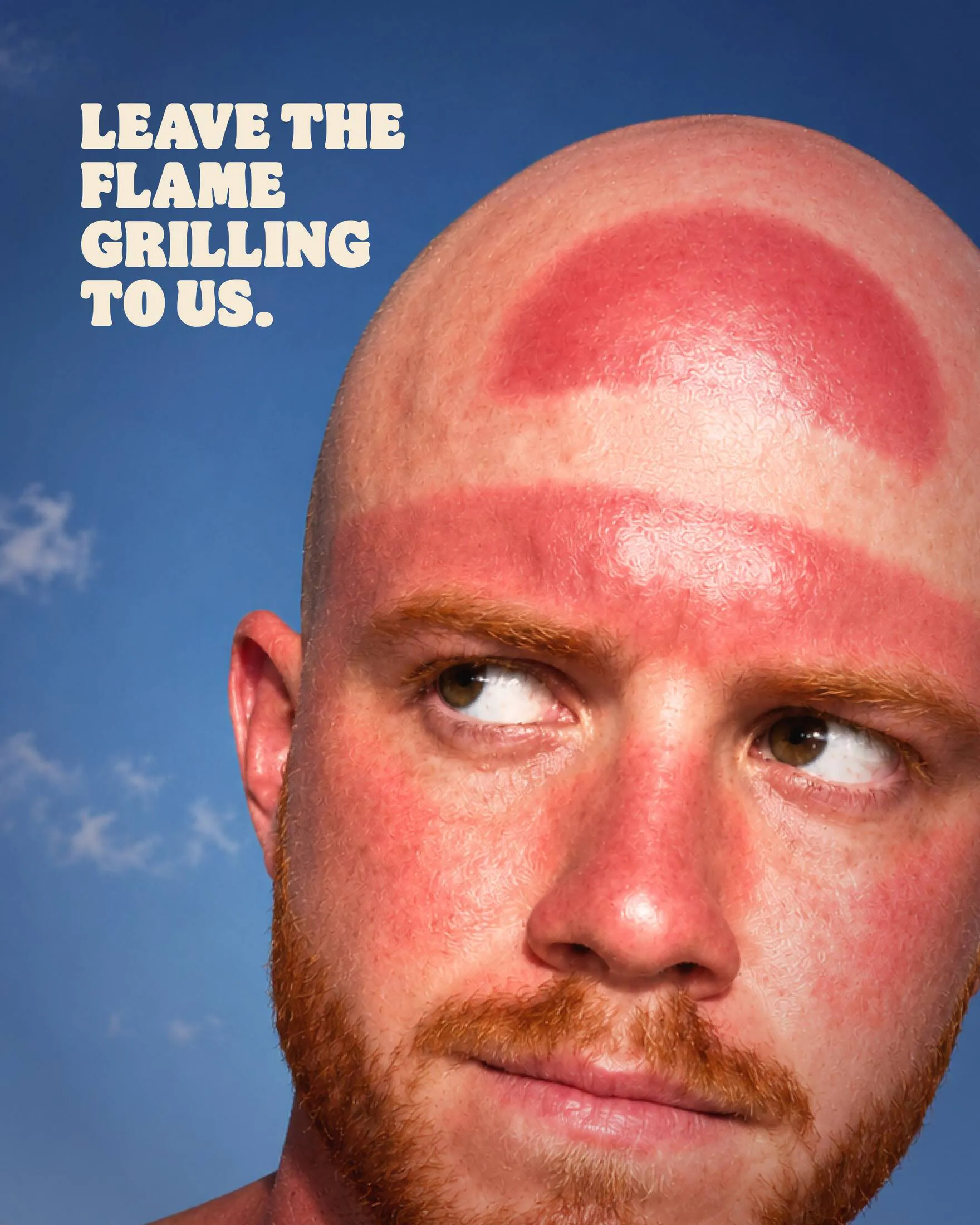 Frente de un hombre calvo quemada por el sol con la marca de una gorra, en la campaña de Burger King